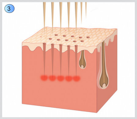 Illustratiion på microneedling i huden